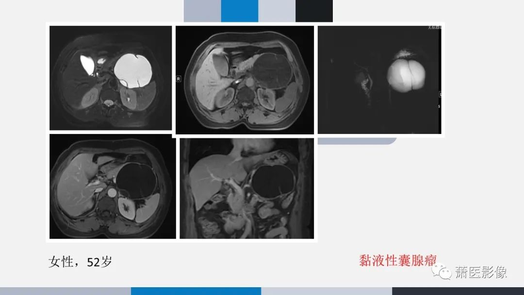 影像PPT - 【PPT】常见胰腺囊性肿瘤-50