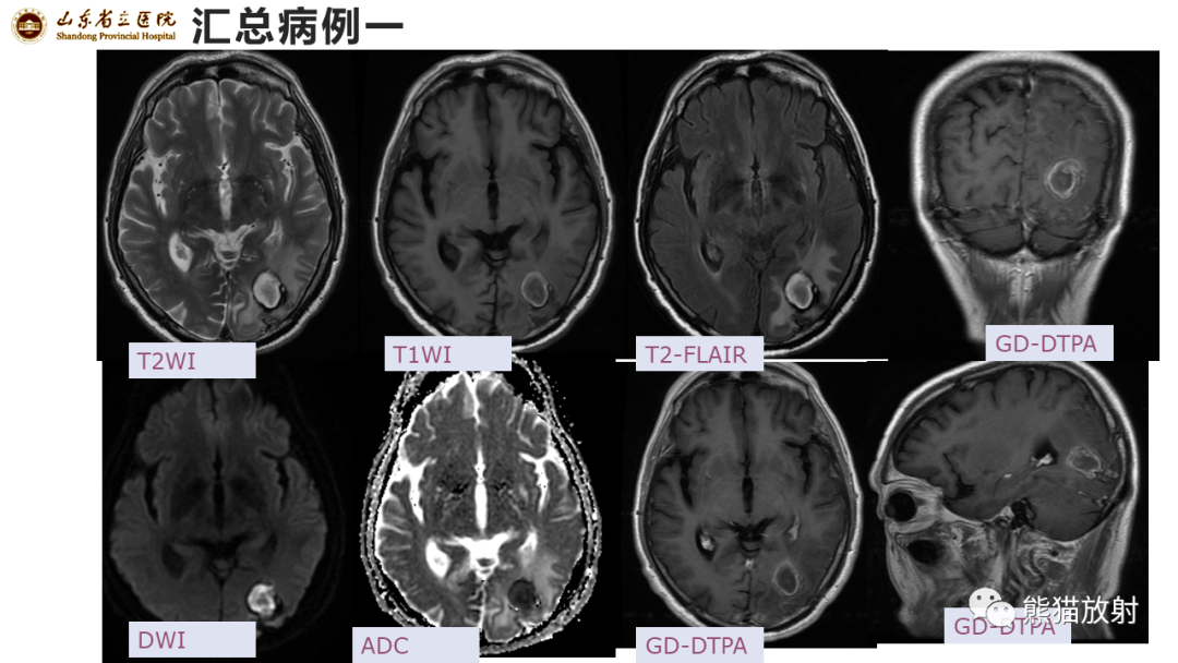 影像PPT - 【病例】炎性肉芽肿并脓肿形成 & 成熟性囊性畸胎瘤-3