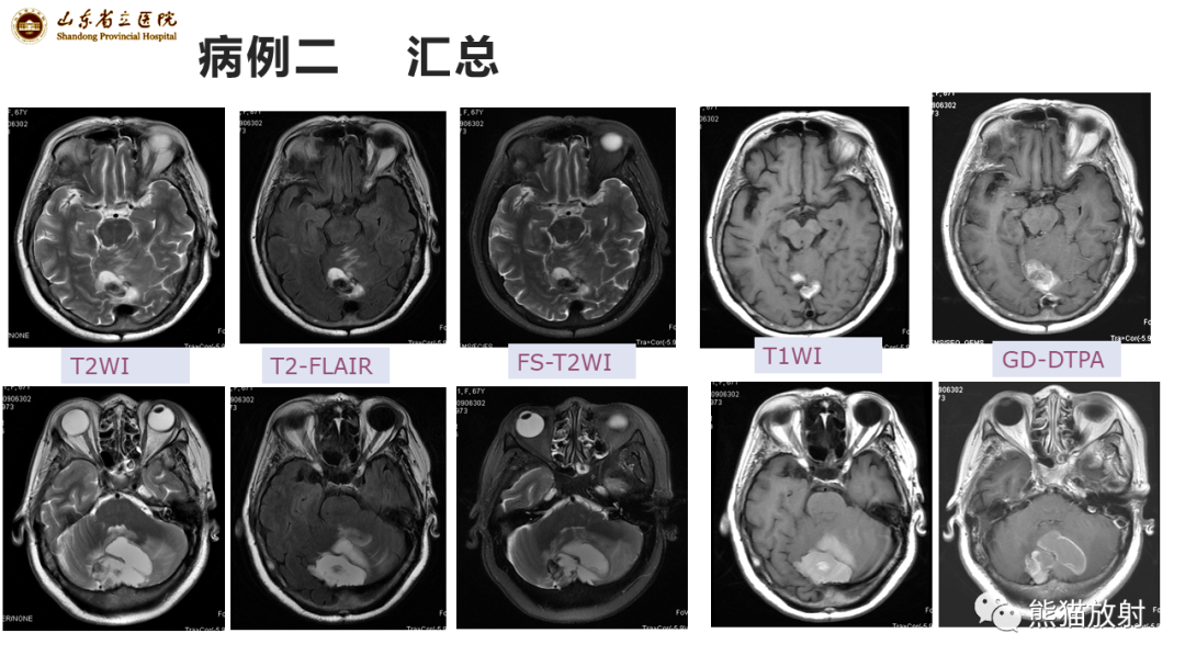 影像PPT - 【病例】炎性肉芽肿并脓肿形成 & 成熟性囊性畸胎瘤-7