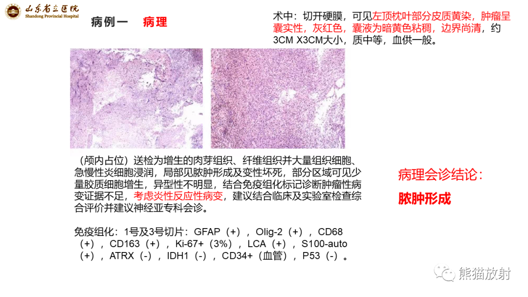 影像PPT - 【病例】炎性肉芽肿并脓肿形成 & 成熟性囊性畸胎瘤-11