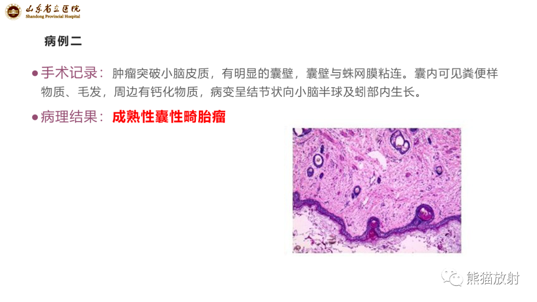 影像PPT - 【病例】炎性肉芽肿并脓肿形成 & 成熟性囊性畸胎瘤-12