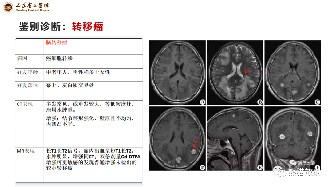 影像PPT - 【病例】炎性肉芽肿并脓肿形成 & 成熟性囊性畸胎瘤-14