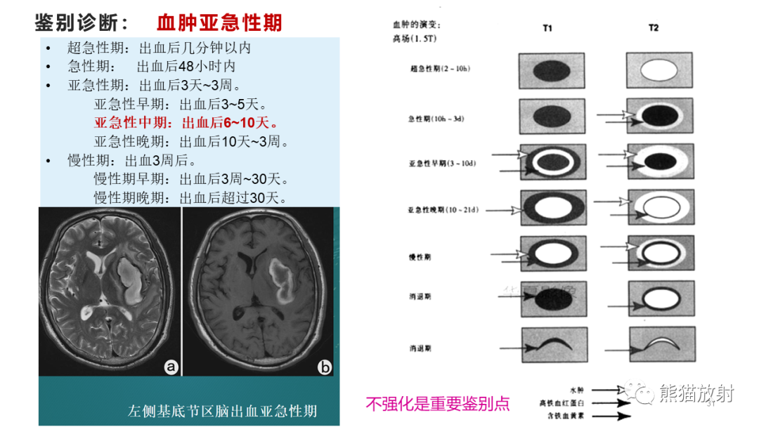 影像PPT - 【病例】炎性肉芽肿并脓肿形成 & 成熟性囊性畸胎瘤-15