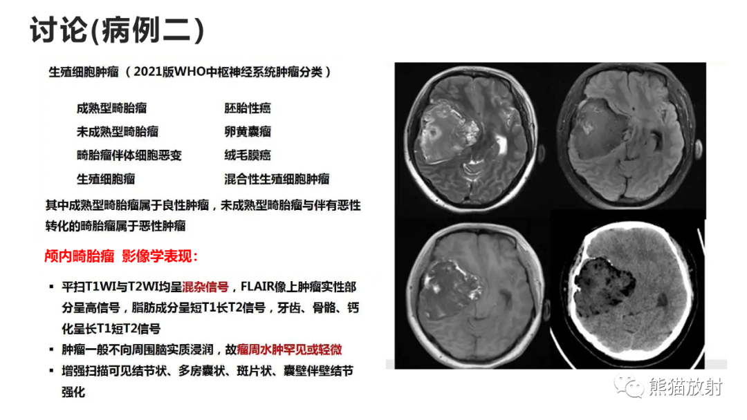 影像PPT - 【病例】炎性肉芽肿并脓肿形成 & 成熟性囊性畸胎瘤-16