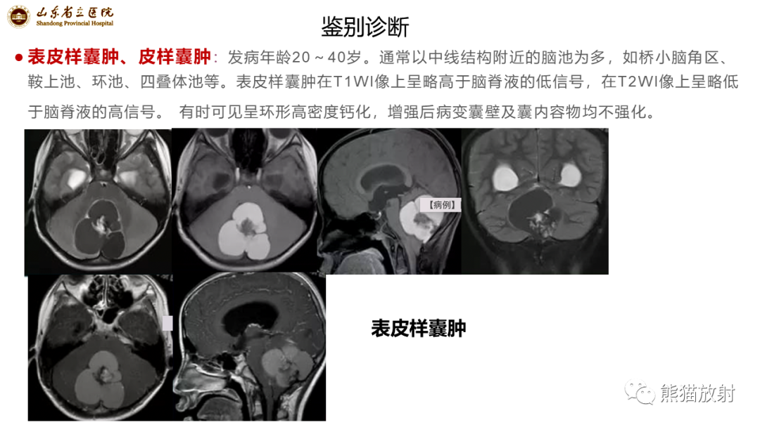 影像PPT - 【病例】炎性肉芽肿并脓肿形成 & 成熟性囊性畸胎瘤-17