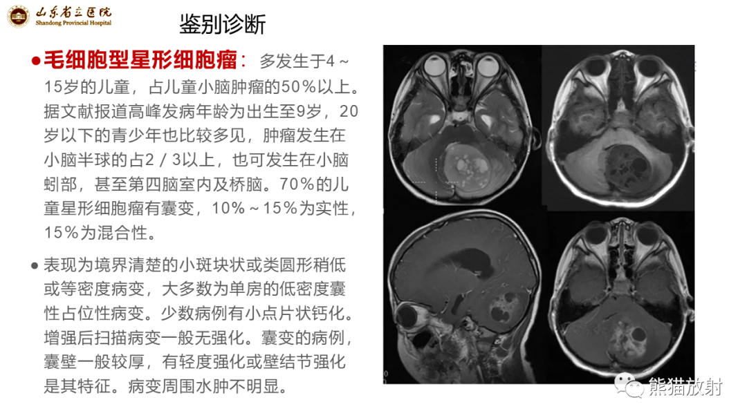 影像PPT - 【病例】炎性肉芽肿并脓肿形成 & 成熟性囊性畸胎瘤-18