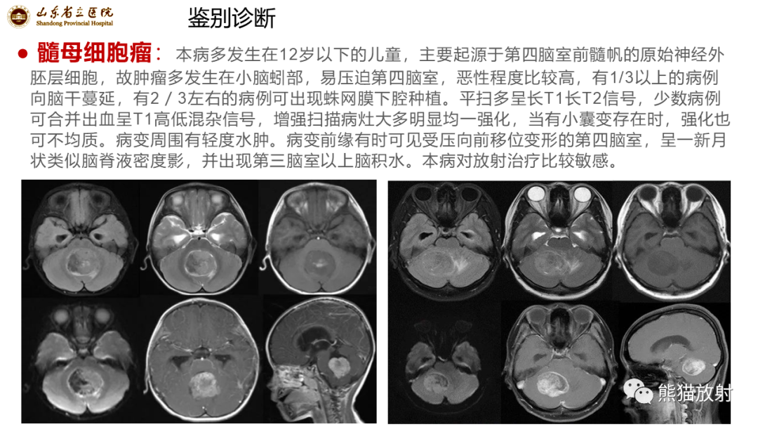 影像PPT - 【病例】炎性肉芽肿并脓肿形成 & 成熟性囊性畸胎瘤-19