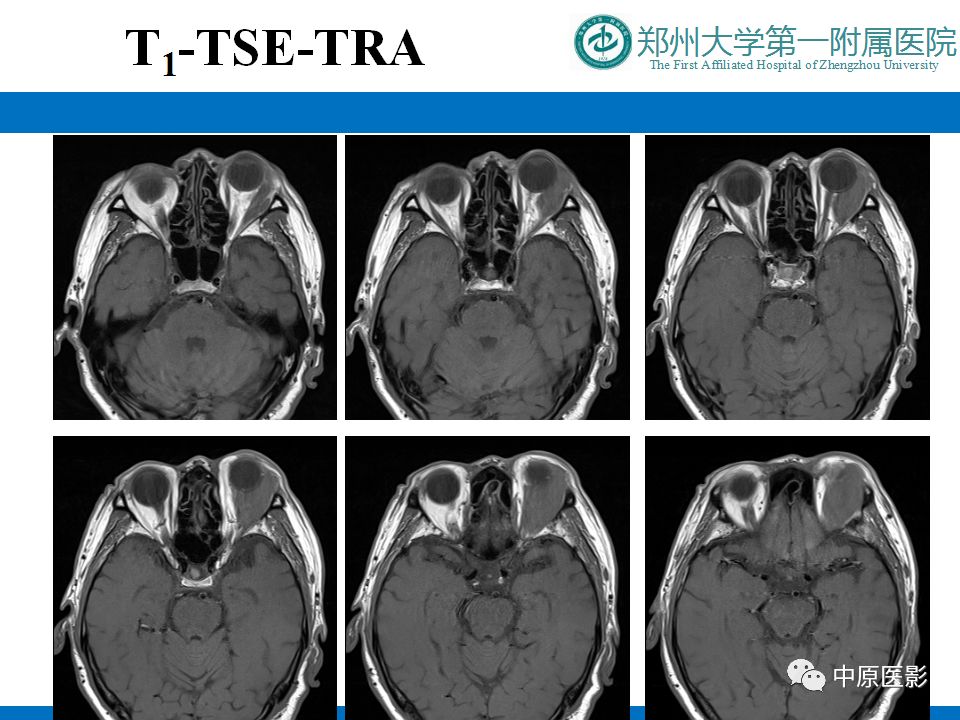 影像PPT - 【PPT】泪腺IgG4相关硬化性疾病1例MR-3