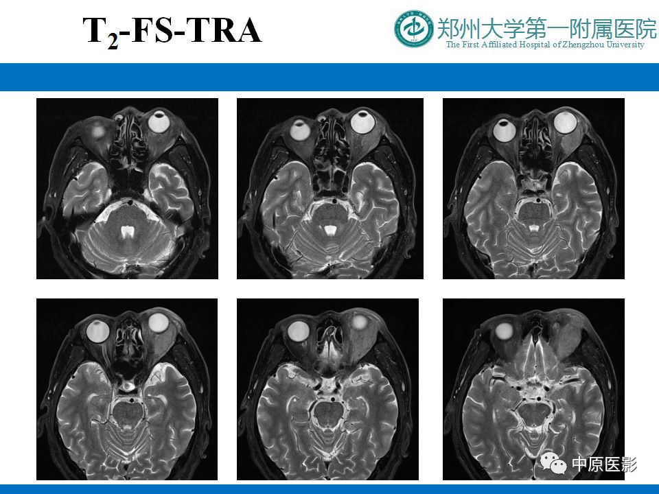 影像PPT - 【PPT】泪腺IgG4相关硬化性疾病1例MR-4