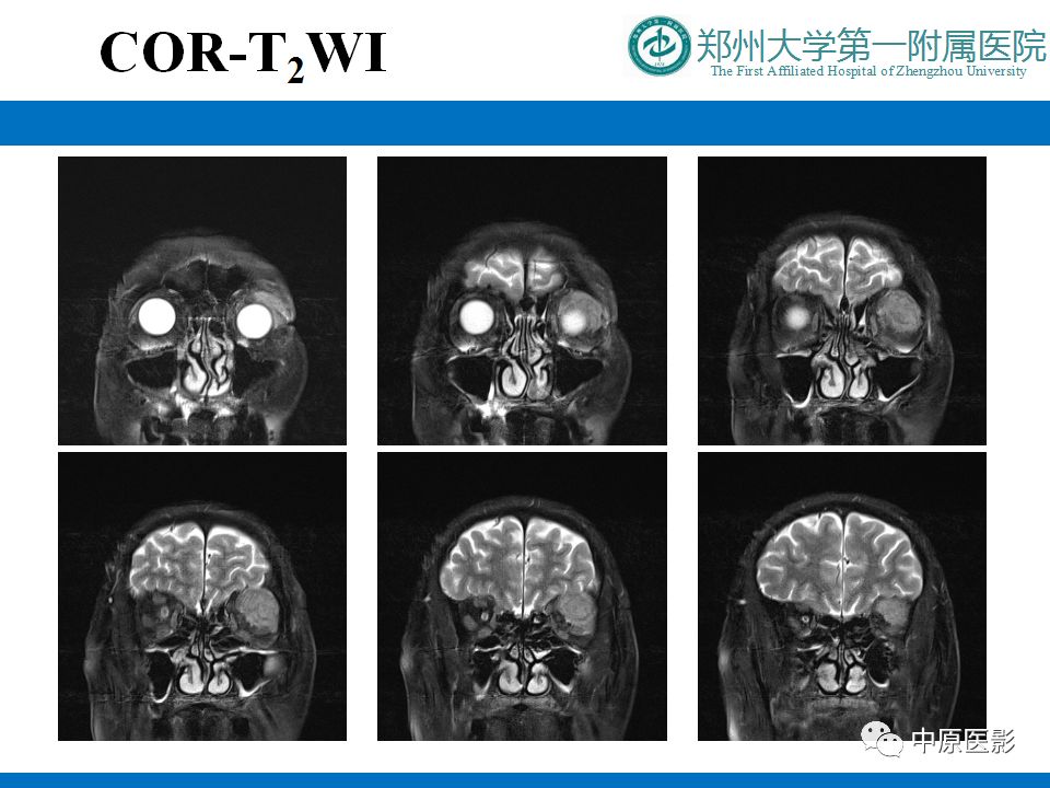 影像PPT - 【PPT】泪腺IgG4相关硬化性疾病1例MR-5