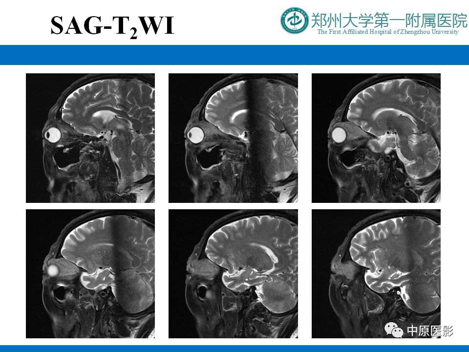影像PPT - 【PPT】泪腺IgG4相关硬化性疾病1例MR-6