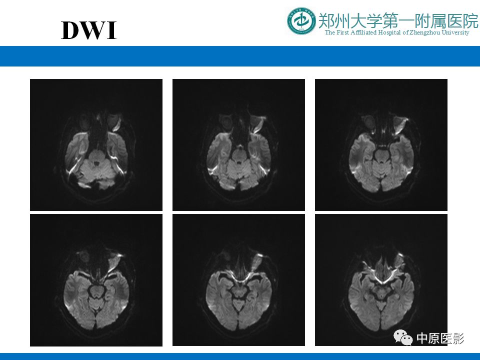 影像PPT - 【PPT】泪腺IgG4相关硬化性疾病1例MR-7