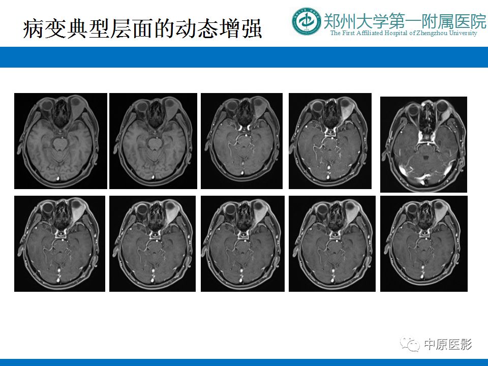 影像PPT - 【PPT】泪腺IgG4相关硬化性疾病1例MR-8