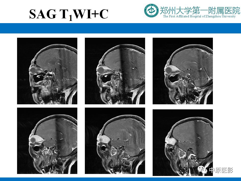 影像PPT - 【PPT】泪腺IgG4相关硬化性疾病1例MR-10
