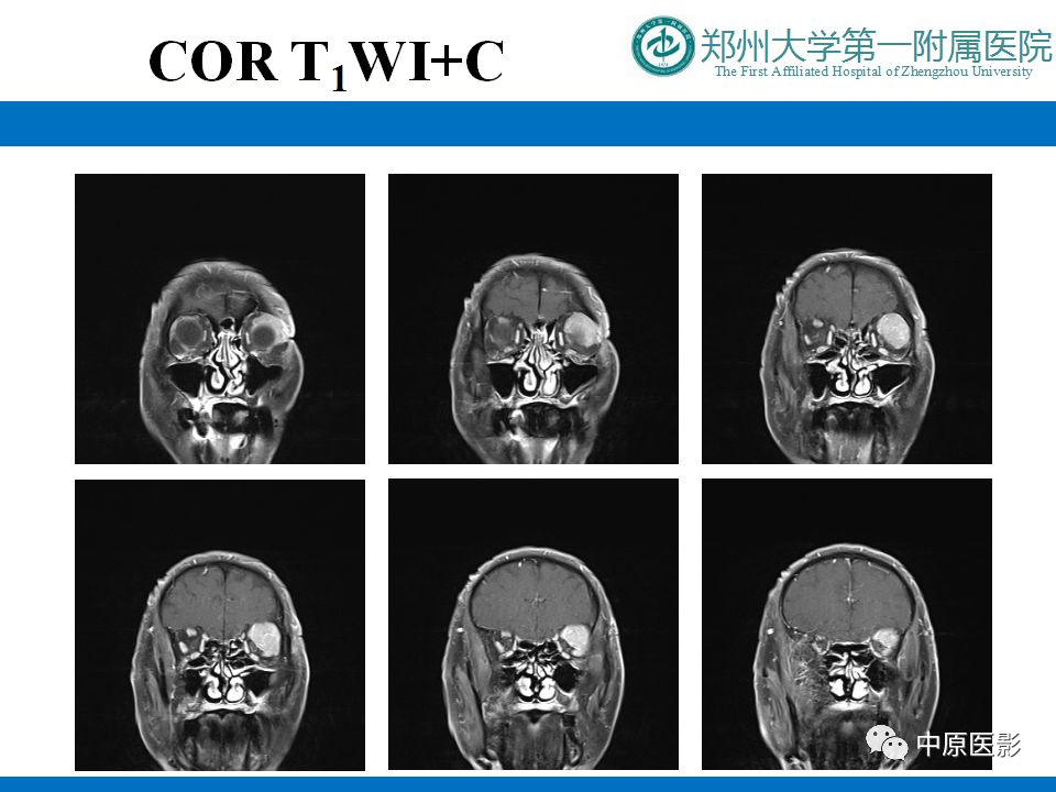 影像PPT - 【PPT】泪腺IgG4相关硬化性疾病1例MR-11