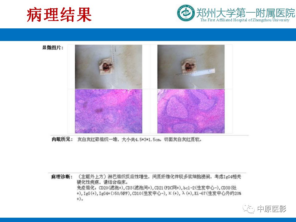 影像PPT - 【PPT】泪腺IgG4相关硬化性疾病1例MR-14