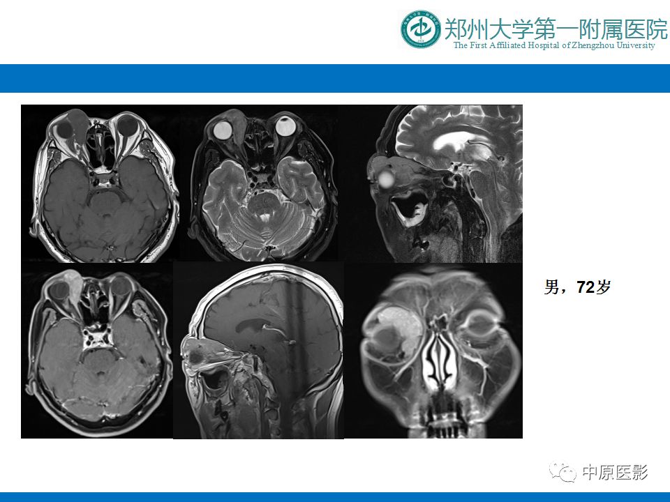 影像PPT - 【PPT】泪腺IgG4相关硬化性疾病1例MR-21