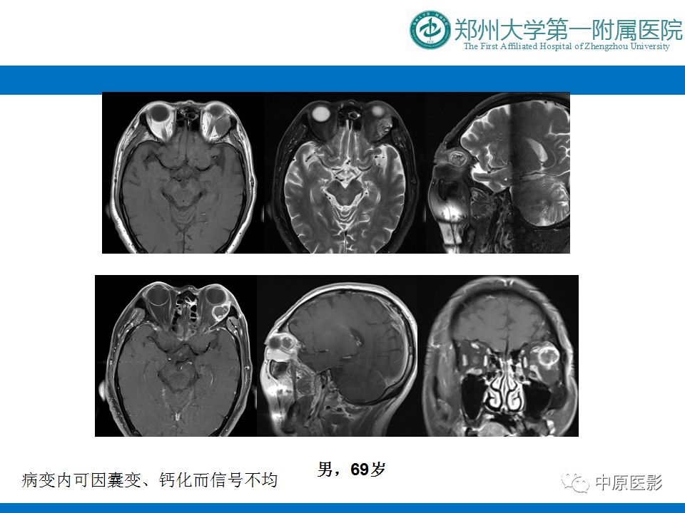 影像PPT - 【PPT】泪腺IgG4相关硬化性疾病1例MR-24