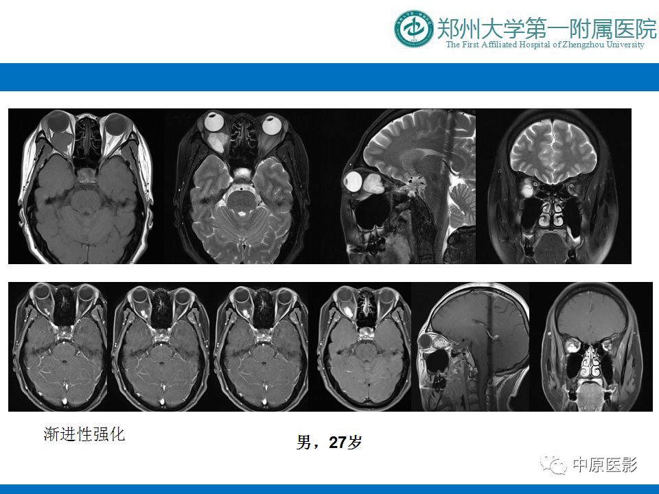 影像PPT - 【PPT】泪腺IgG4相关硬化性疾病1例MR-30