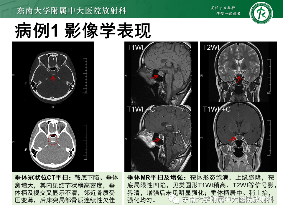 影像PPT - 【PPT】垂体Rathke囊肿-2