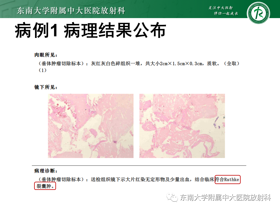 影像PPT - 【PPT】垂体Rathke囊肿-3