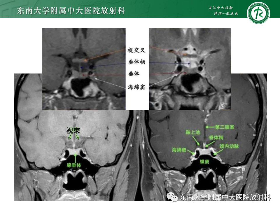 影像PPT - 【PPT】垂体Rathke囊肿-8