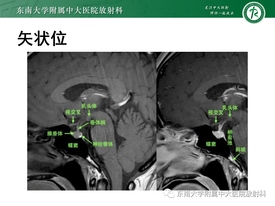 影像PPT - 【PPT】垂体Rathke囊肿-9