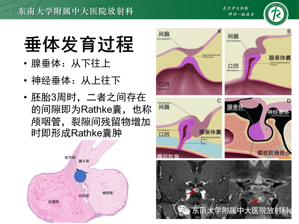 影像PPT - 【PPT】垂体Rathke囊肿-11