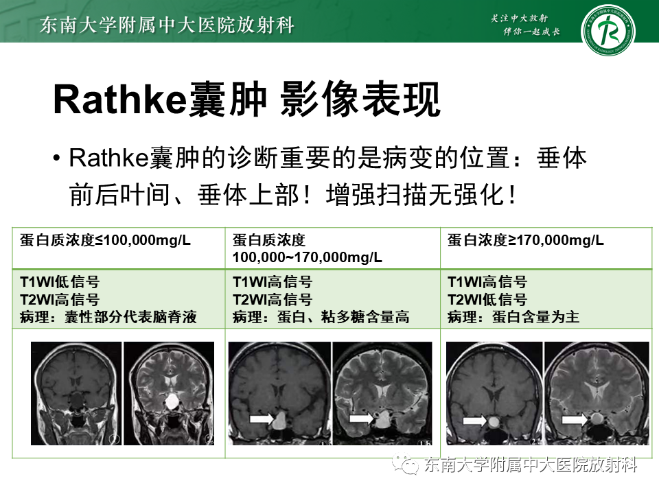 影像PPT - 【PPT】垂体Rathke囊肿-13