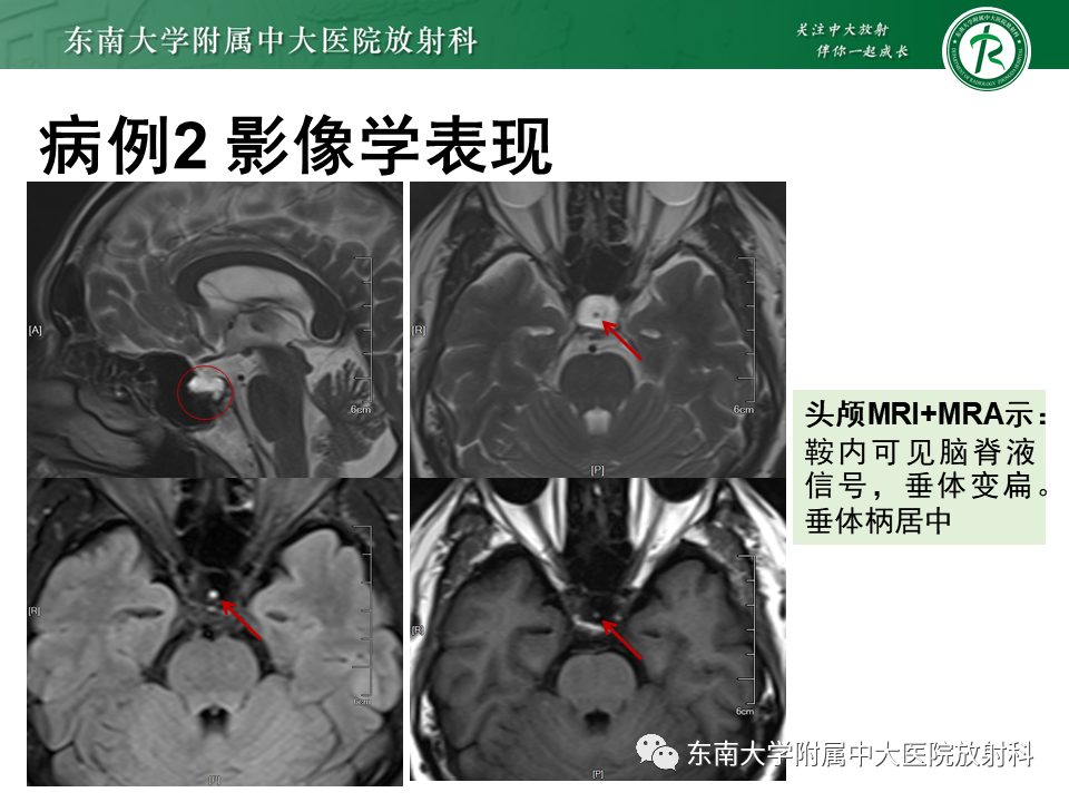 影像PPT - 【PPT】垂体Rathke囊肿-16