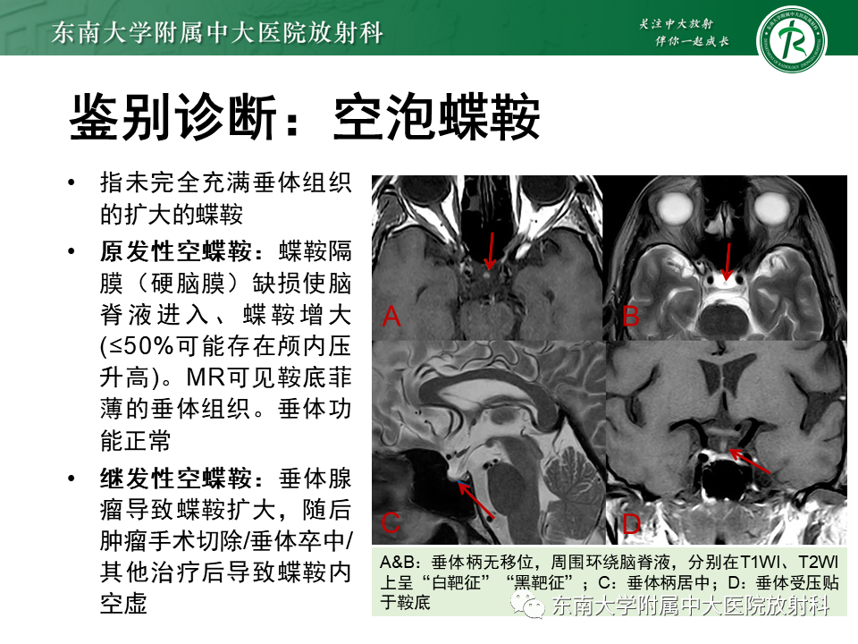 影像PPT - 【PPT】垂体Rathke囊肿-17