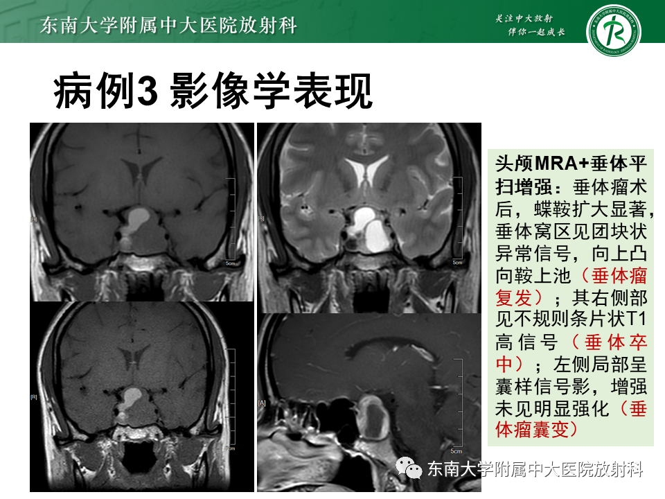 影像PPT - 【PPT】垂体Rathke囊肿-20