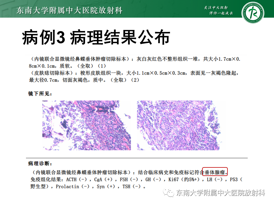 影像PPT - 【PPT】垂体Rathke囊肿-21