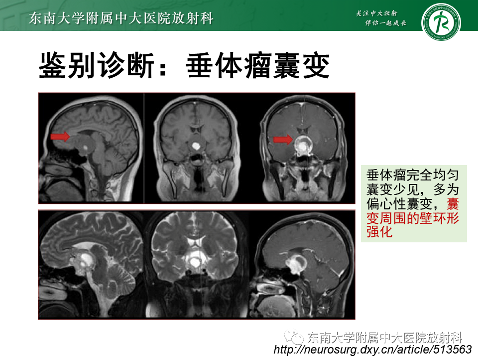 影像PPT - 【PPT】垂体Rathke囊肿-22