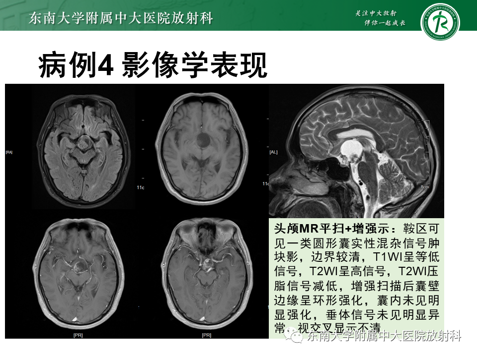 影像PPT - 【PPT】垂体Rathke囊肿-24