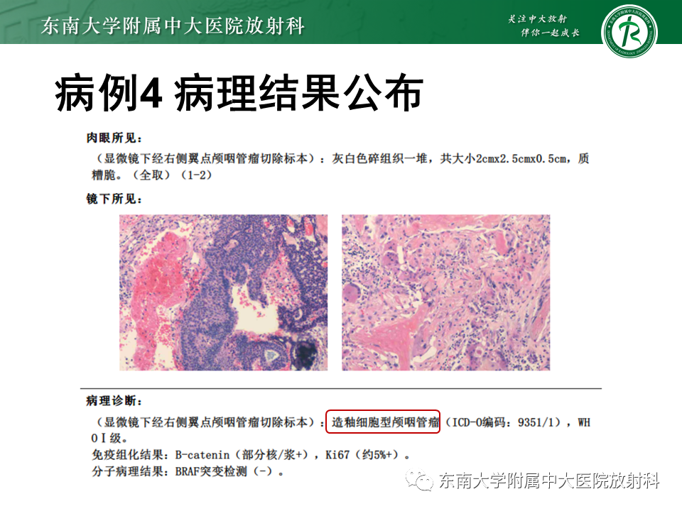 影像PPT - 【PPT】垂体Rathke囊肿-25