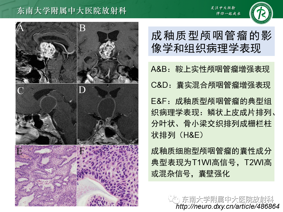 影像PPT - 【PPT】垂体Rathke囊肿-28