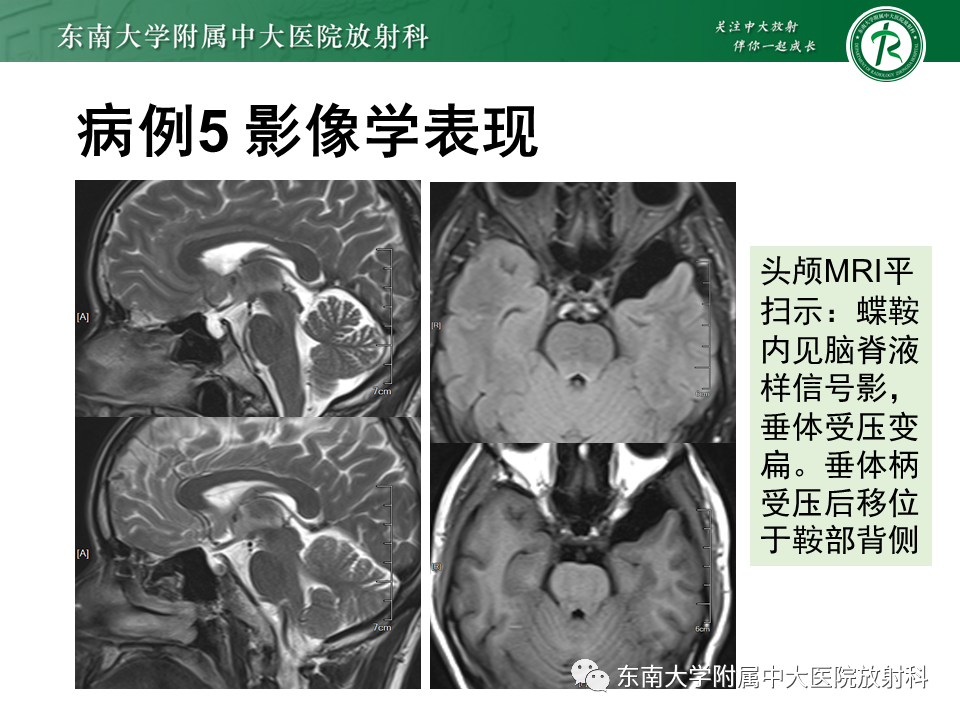 影像PPT - 【PPT】垂体Rathke囊肿-31