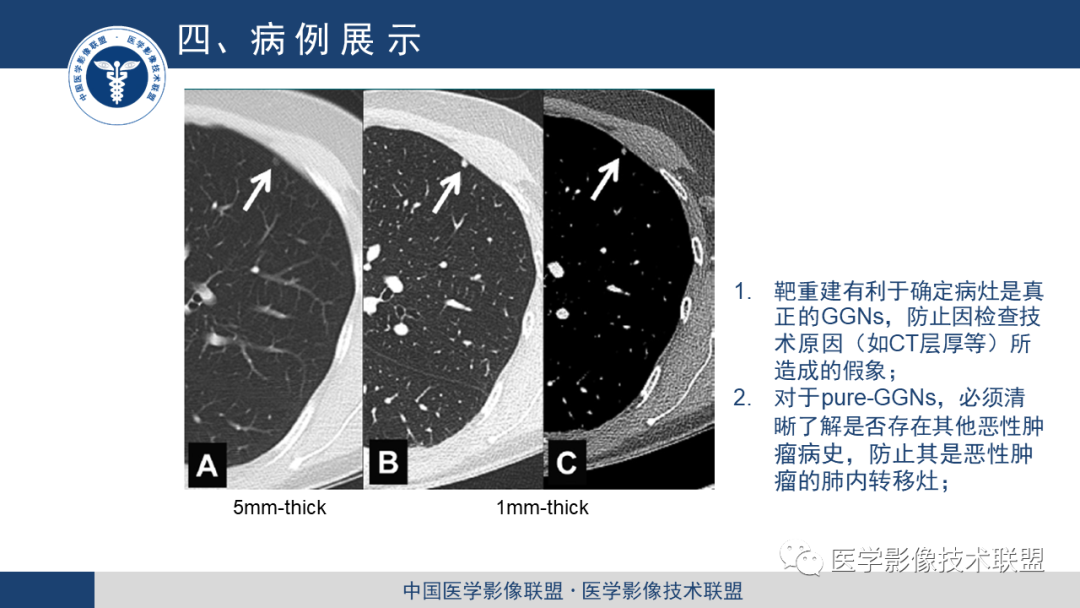 影像PPT - 【PPT】靶重建技术综述-7