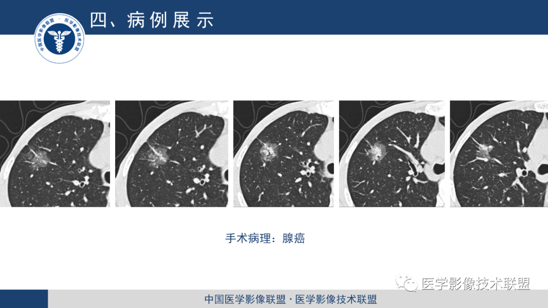 影像PPT - 【PPT】靶重建技术综述-10