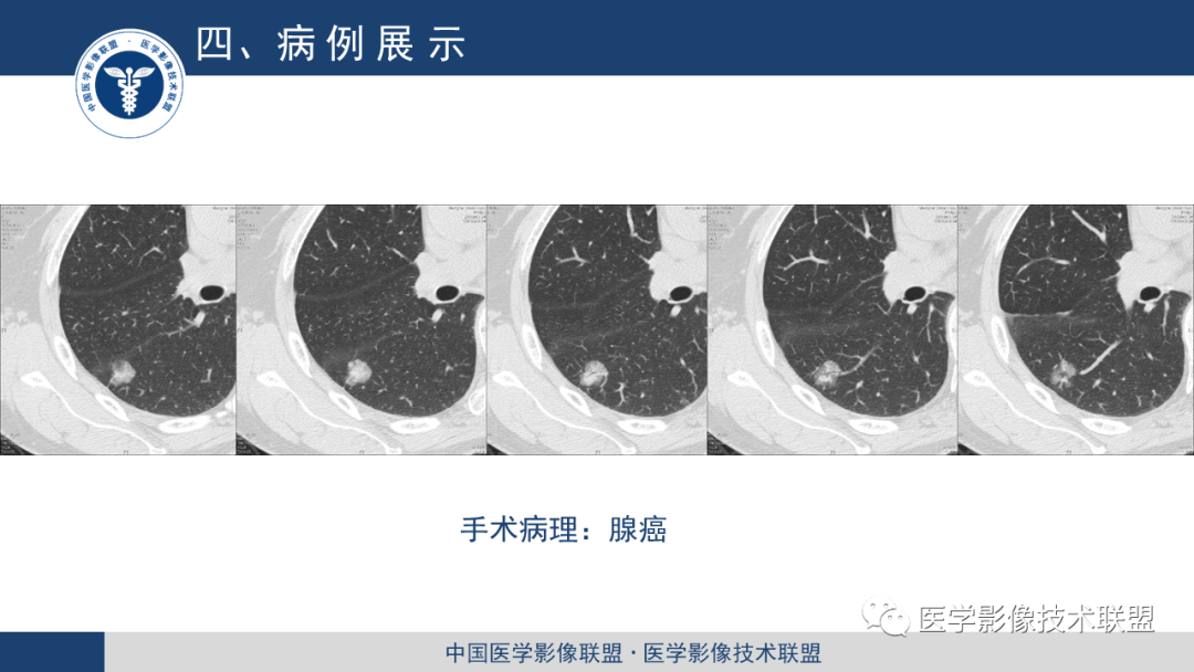 影像PPT - 【PPT】靶重建技术综述-11