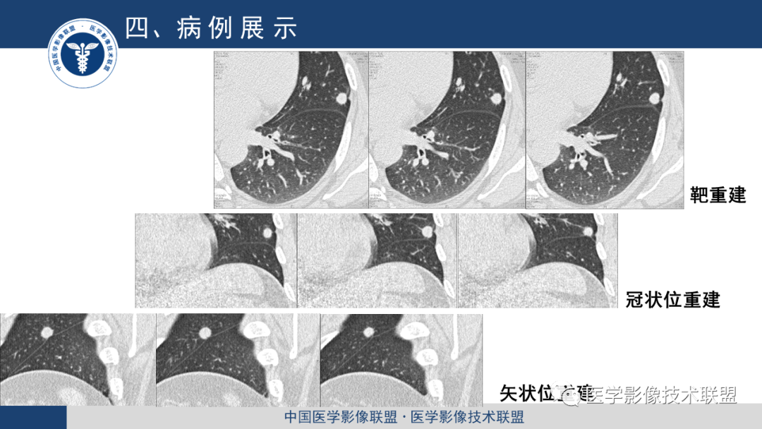 影像PPT - 【PPT】靶重建技术综述-12