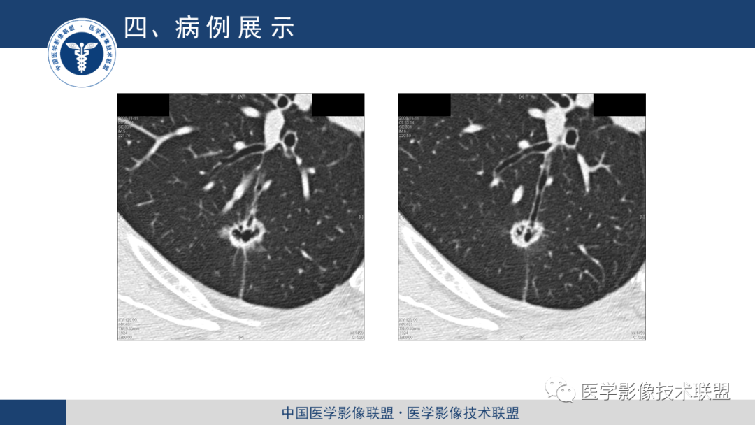 影像PPT - 【PPT】靶重建技术综述-13