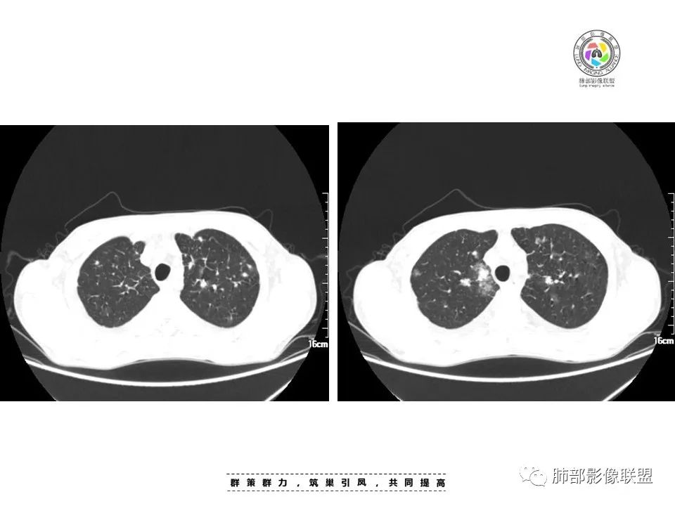 影像PPT - 【病例】HIV卡波西肉瘤1例肺部影像表现-5