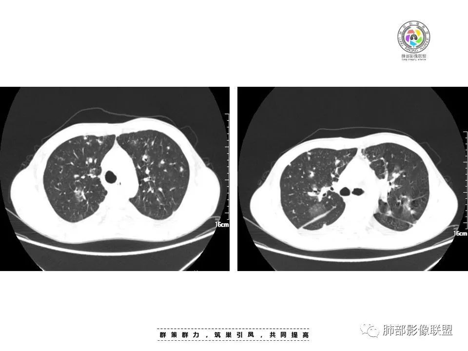 影像PPT - 【病例】HIV卡波西肉瘤1例肺部影像表现-6