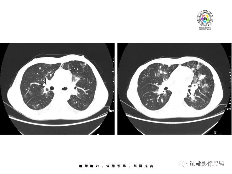 影像PPT - 【病例】HIV卡波西肉瘤1例肺部影像表现-7