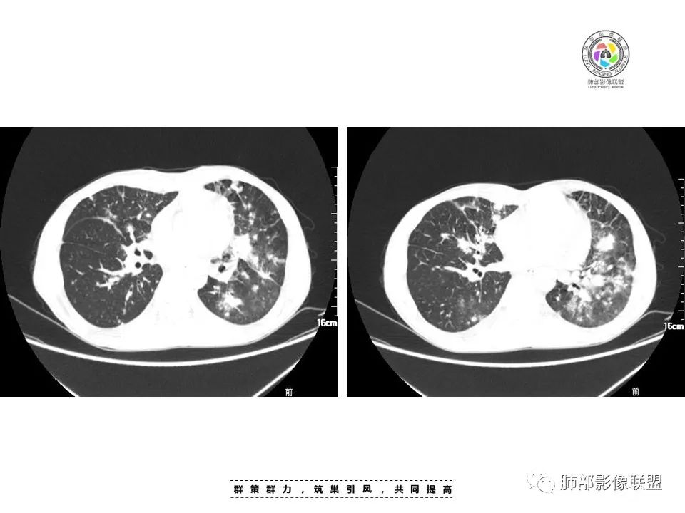 影像PPT - 【病例】HIV卡波西肉瘤1例肺部影像表现-8