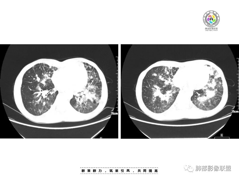 影像PPT - 【病例】HIV卡波西肉瘤1例肺部影像表现-9