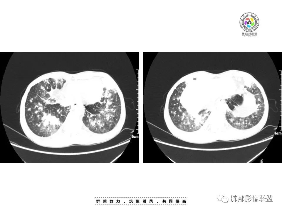 影像PPT - 【病例】HIV卡波西肉瘤1例肺部影像表现-10