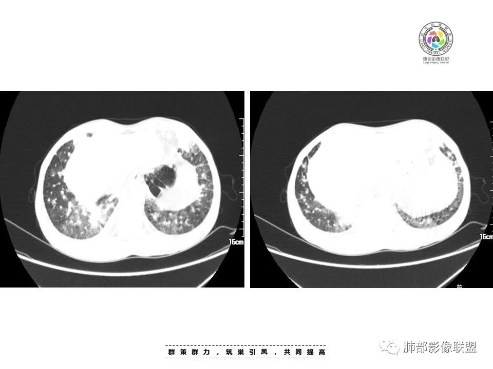 影像PPT - 【病例】HIV卡波西肉瘤1例肺部影像表现-11